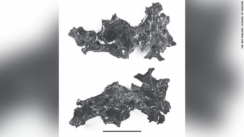 ガラス状の物質となった脳の残留物/The New England Journal of Medicine