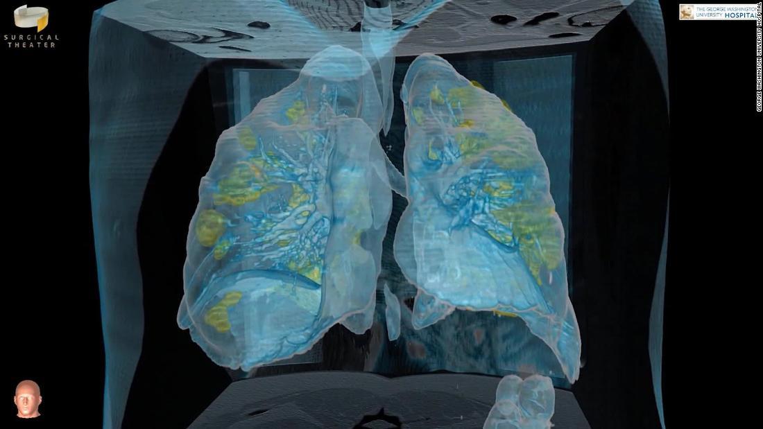 CNN.co.jp 新型コロナ感染者の肺、立体動画を公開 米病院