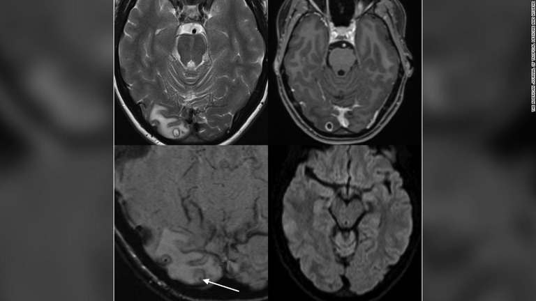 ＭＲＩ検査によって脳の中に嚢胞（のうほう）が見つかった/The American Journal of Tropical Medicine and Hygiene