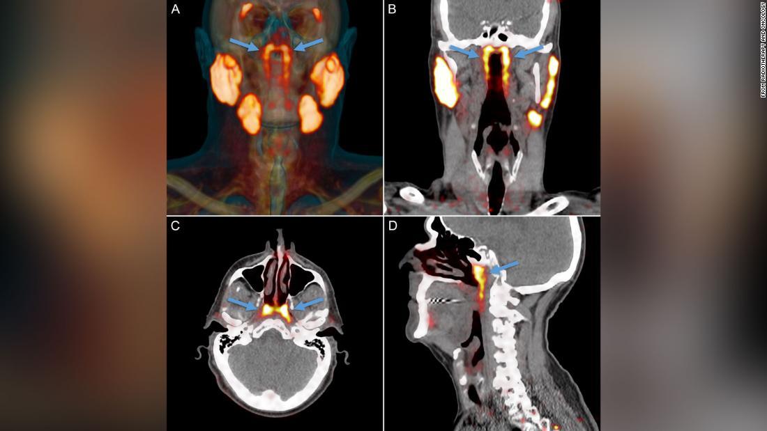 ＰＳＭＡ　ＰＥＴ／ＣＴスキャンの画像/From Radiotherapy and Oncology