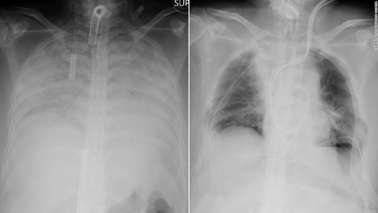 手術前（左）と後の患者の胸部レントゲン図。肺組織の移植箇所が黒く写っている/Kyoto University Hospital 