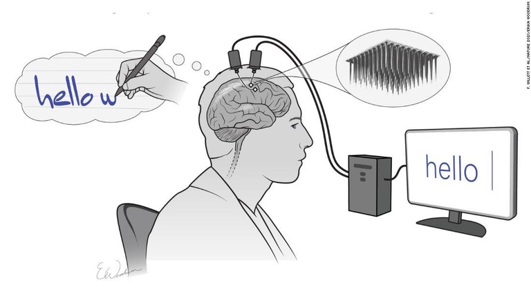 小さな２つのセンサーが、手と腕の動きをつかさどる脳の部位からの情報をアルゴリズムに伝え、それが翻訳されてスクリーンに表示される/ F. Willett et al./Nature 2021/Erika Woodrum