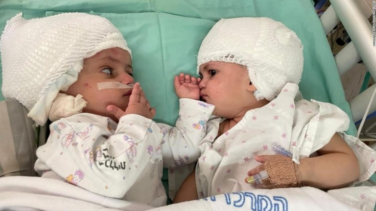 手術によって分離された双子の女児＝５日、イスラエル南部ベエルシェバ/Sorokaa Medical Centre/Reuters
