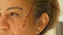 女性はクマに襲われ顔に傷を負った