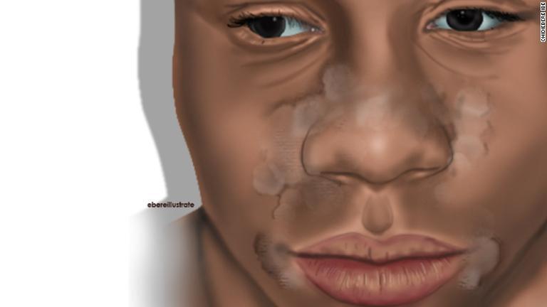 脂漏性湿疹は赤く油っぽい肌の状態を引き起こす一般的な皮膚炎だが、黒い肌の場合、患部が周囲の肌よりも明るい色に見える/Chidiebere Ibe