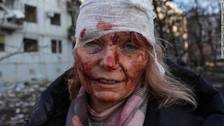 ウクライナ東部ハルキウの集合住宅に空爆があったと報告された。負傷した女性＝２４日/Wolfgang Schwan/Anadolu Agency/Getty Images
