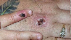 米マサチューセッツ州で「サル痘」の症例確認、スペインや英国でも集団感染