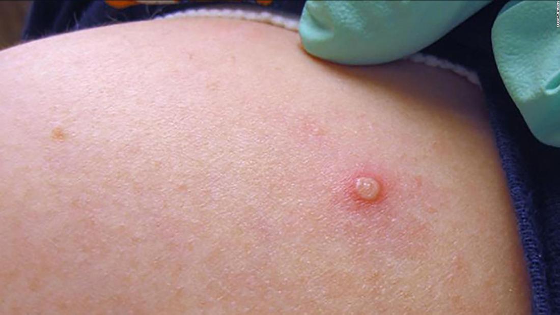 世界３０カ国で５５０件超のサル痘の症例が確認された/EFE