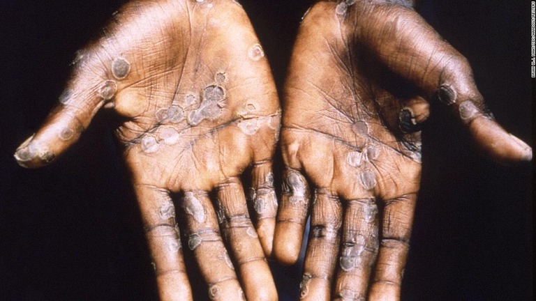 サル痘の患者の手のひら＝１９９７年、コンゴ民主共和国/Brian W.J. Mahy/CDC/Handout/Reuters