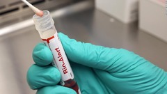 米国でサル痘の検査進まず、「衝撃的」な需要不足　専門家