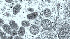 サル痘で米国初の死者、保健当局とＣＤＣが確認