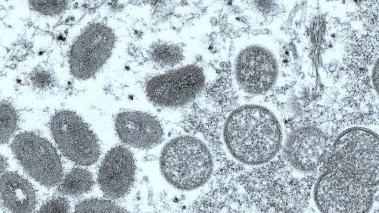 サル痘の死者が米国で初めて確認された/CNN