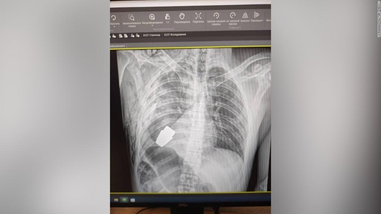 胸部に残った手榴弾を捉えた兵士のＸ線写真/Ukrainian Military Medics