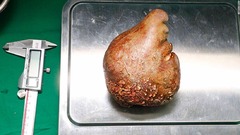 世界最大の腎臓結石を摘出、グレープフルーツ並みの大きさ　スリランカ