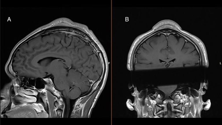 頭皮の腫瘍を報告したブレイクダンサーの頭部のＭＲＩ画像/BMJ Case Reports 2024