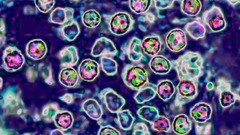 欧州ではしかが急増、１９９７年以降で最悪　ＷＨＯ