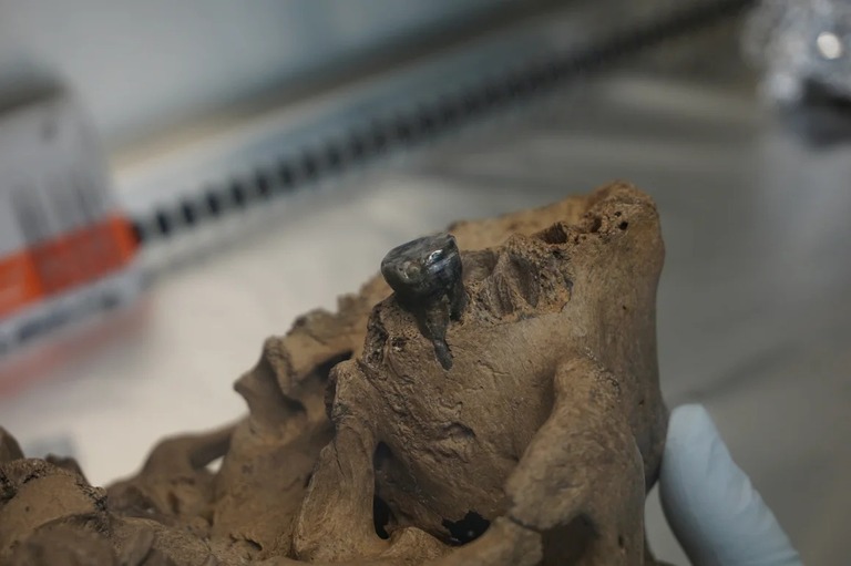 研究者らは歯石からＤＮＡを採集した/Institute of Vertebrate Paleontology and Paleoanthropology of the Chinese Academy of Sciences